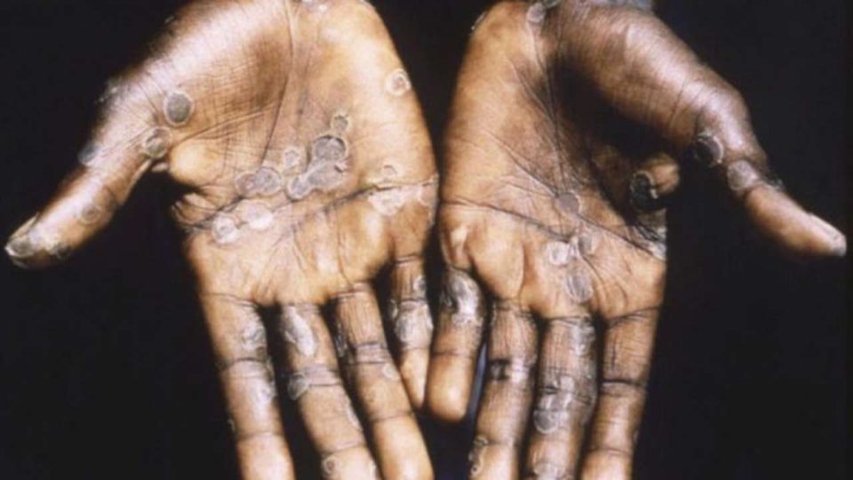 United Kingdom reports two cases of monkeypox, initiates contact