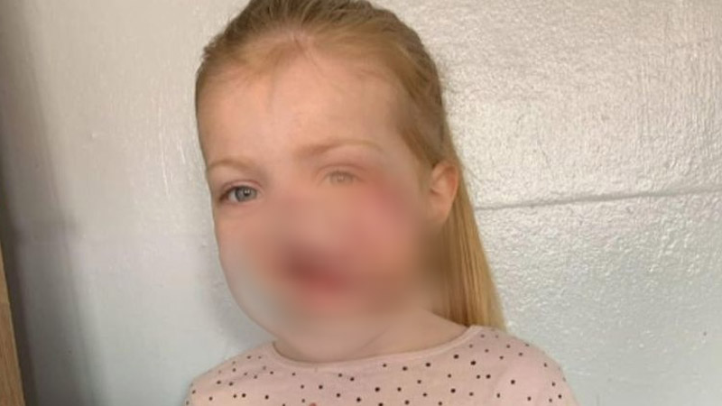 4-Year-Old Girl Who Was Attacked By A Dog